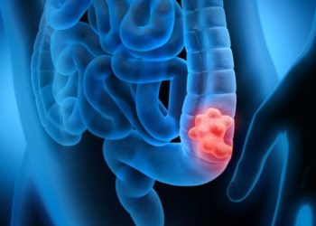 E. coli gut infection linked to bowel cancer