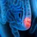 E. coli gut infection linked to bowel cancer